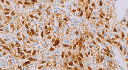 New markers to distinguish well-differentiated liposarcoma from lipoma